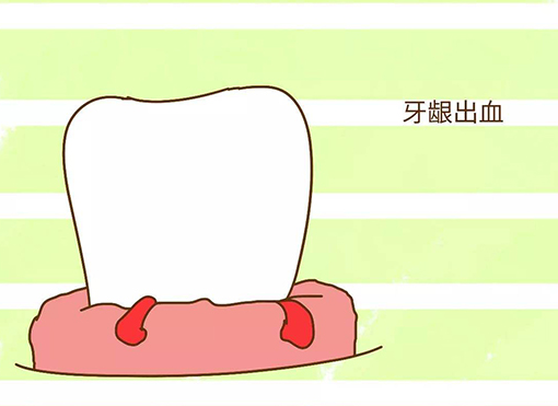 牙龈出血是怎么回事