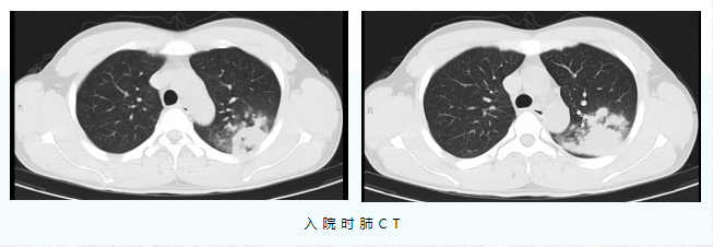 一家3口全部感染 有人肺部现大片炎症 紧急提醒！